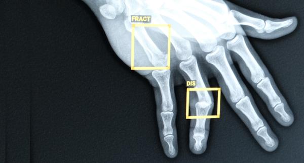 IA : détection de fractures